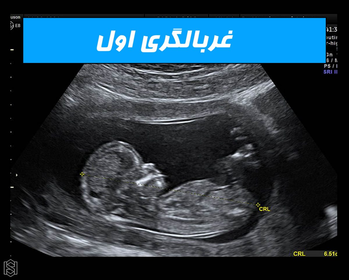 غربالگری سه ماهه اول