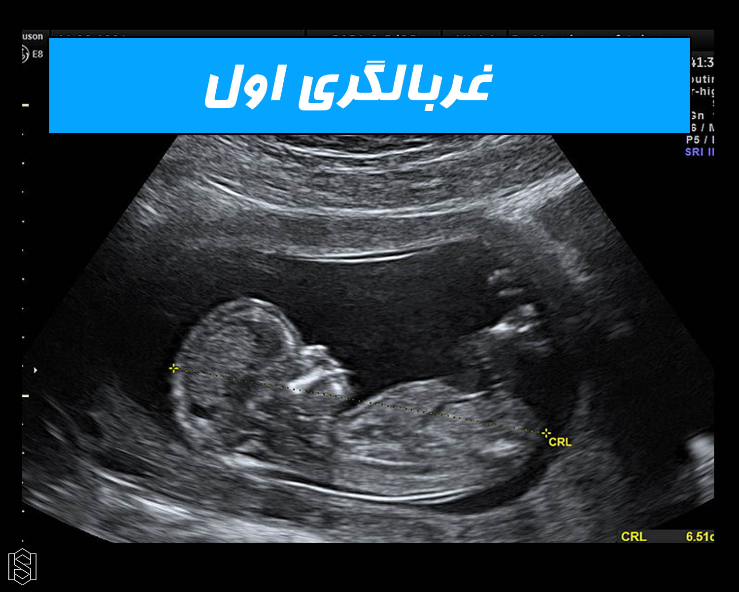 غربالگری سه ماهه اول