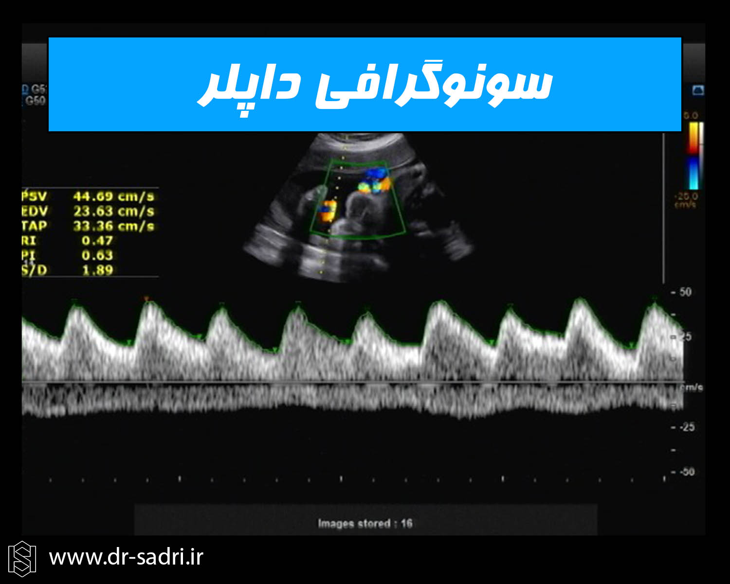 سونوگرافی داپلر