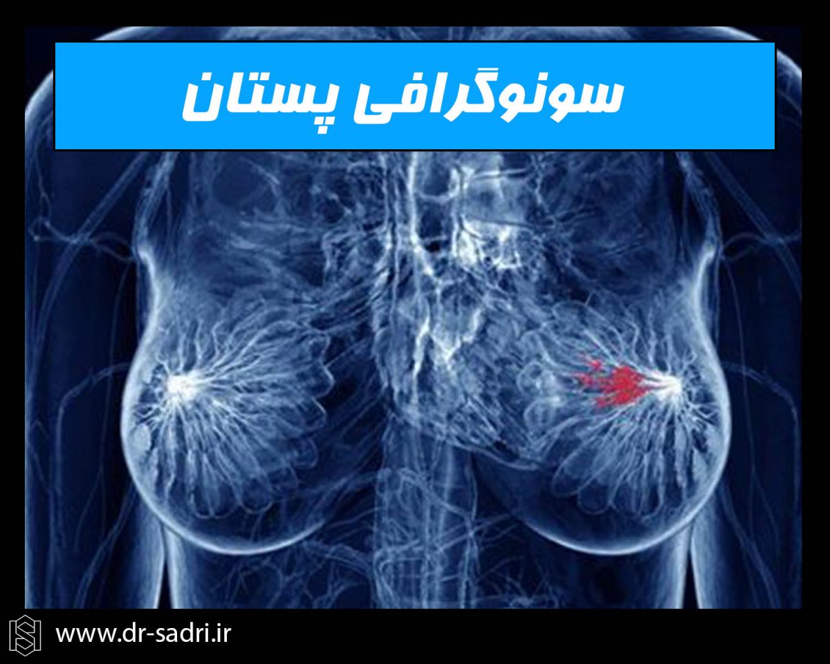 سرطان پستان