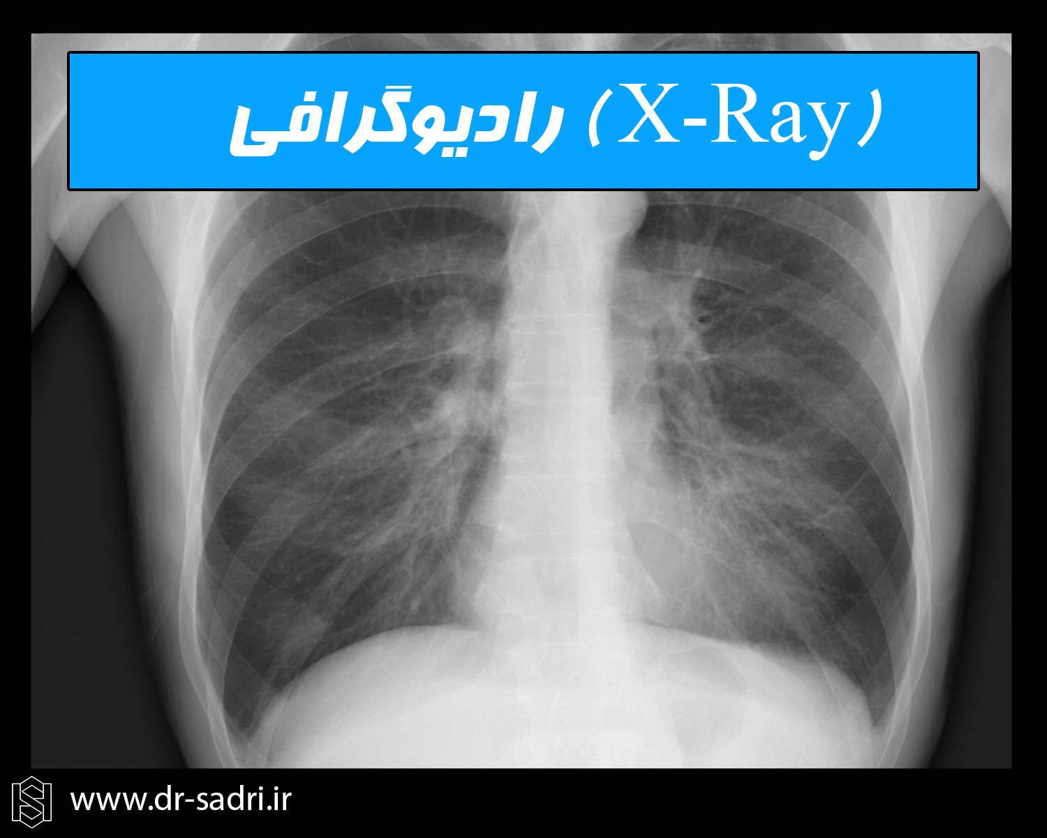 رادیوگرافی ایکس ری