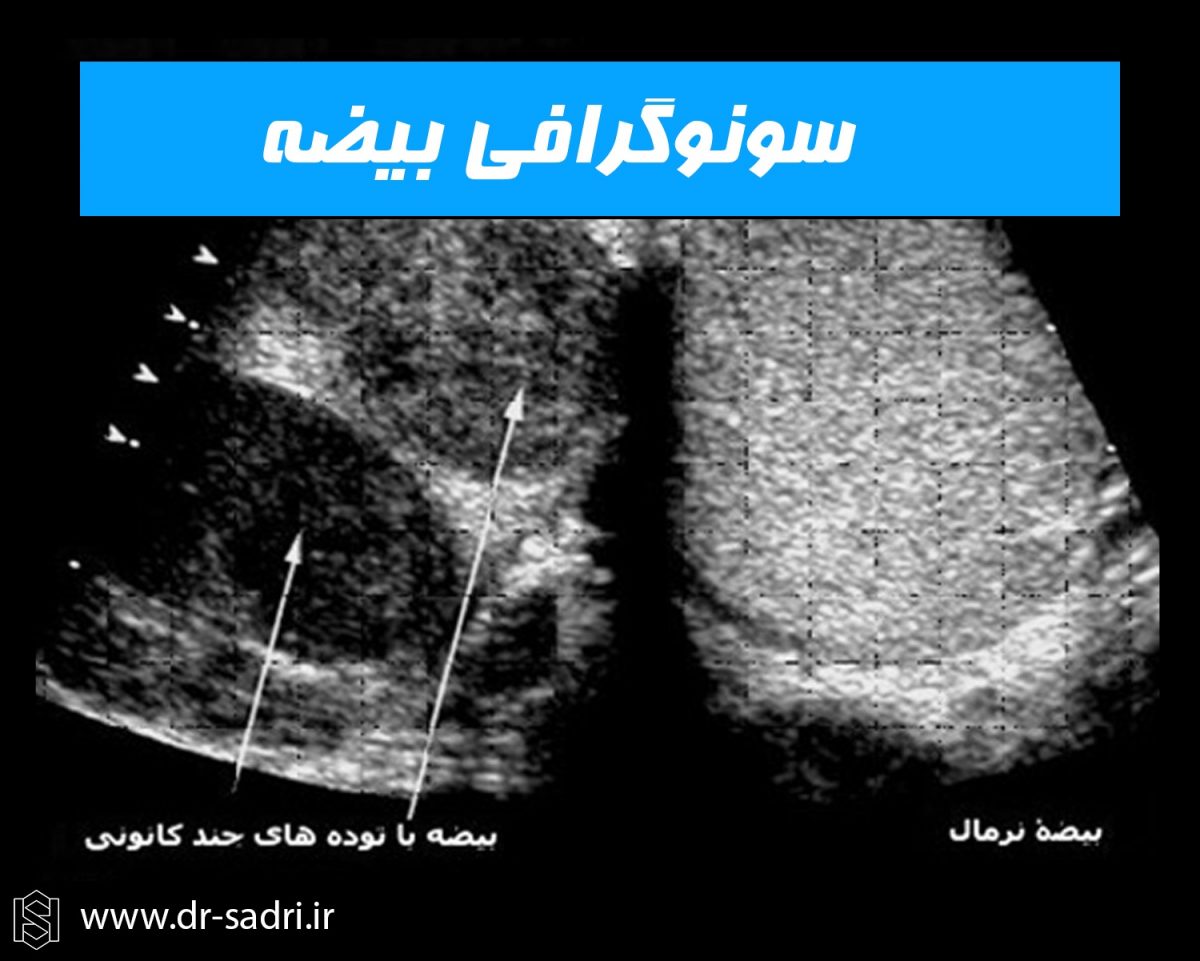 سونوگرافی بیضه
