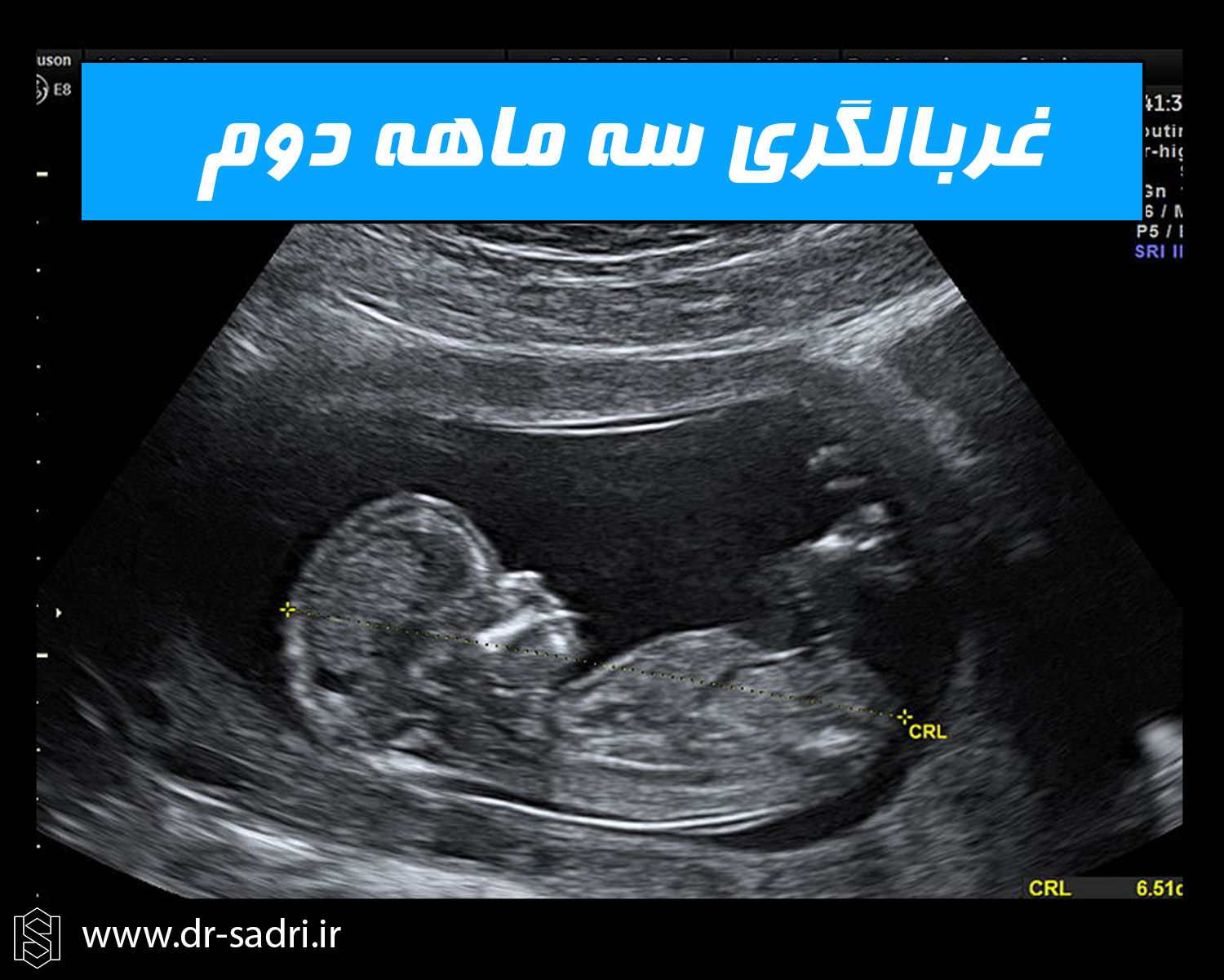 غربالگری سه ماهه دوم بارداری