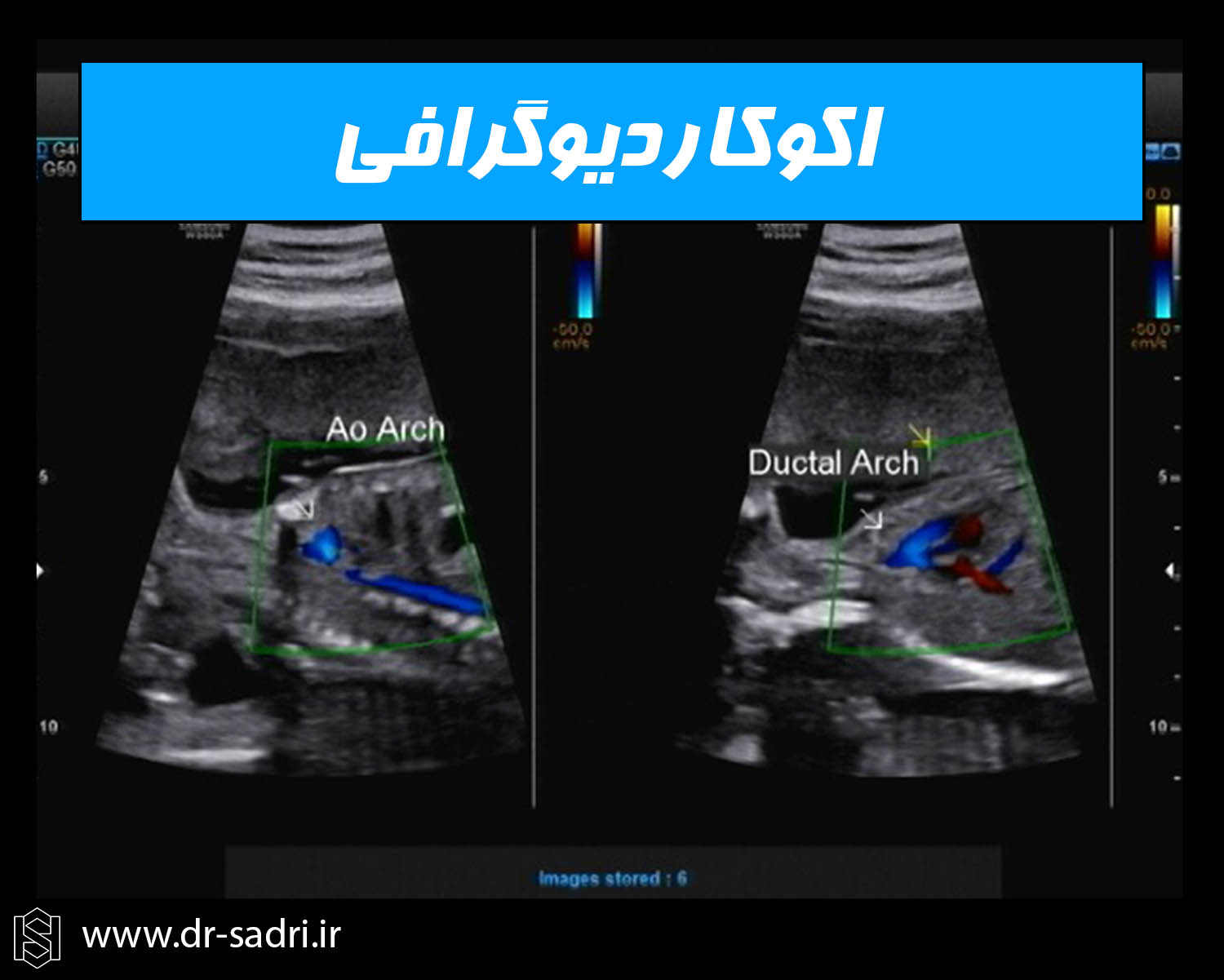 اکوکاردیوگرافی قلب جنین
