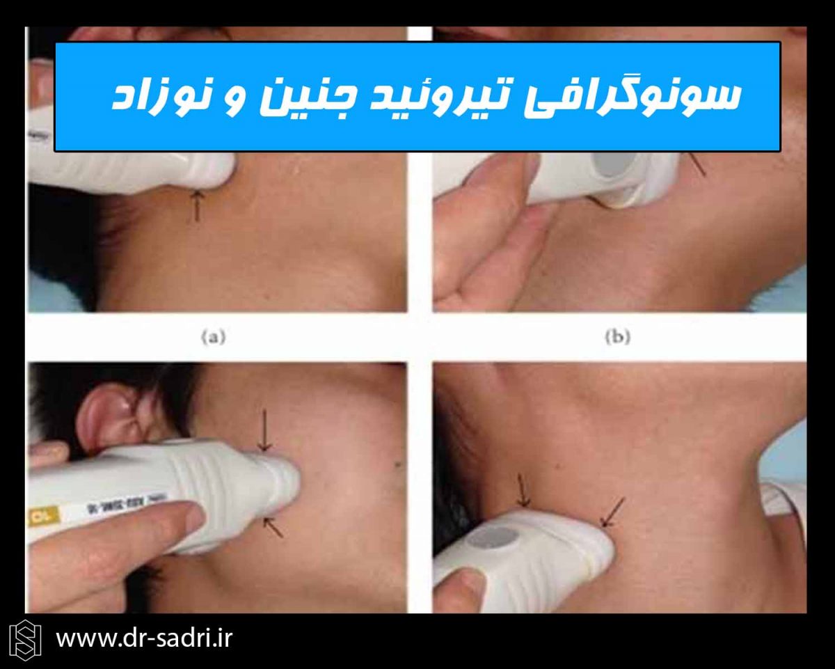 سونوگرافی تیروئید جنین و نوزاد