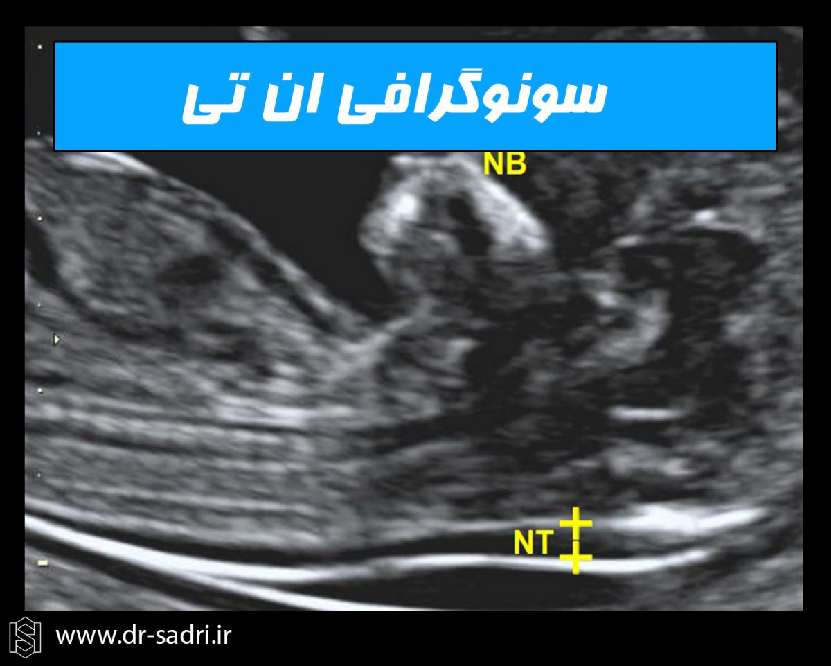 غربالگری سه ماهه اول