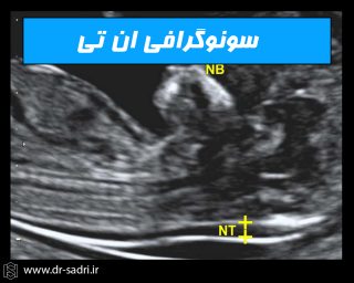 سونوگرافی NT