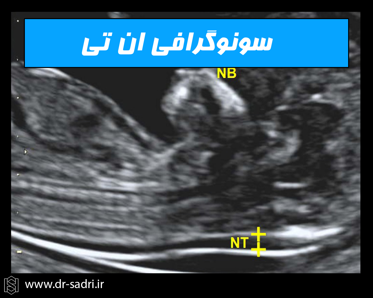 غربالگری سه ماهه اول