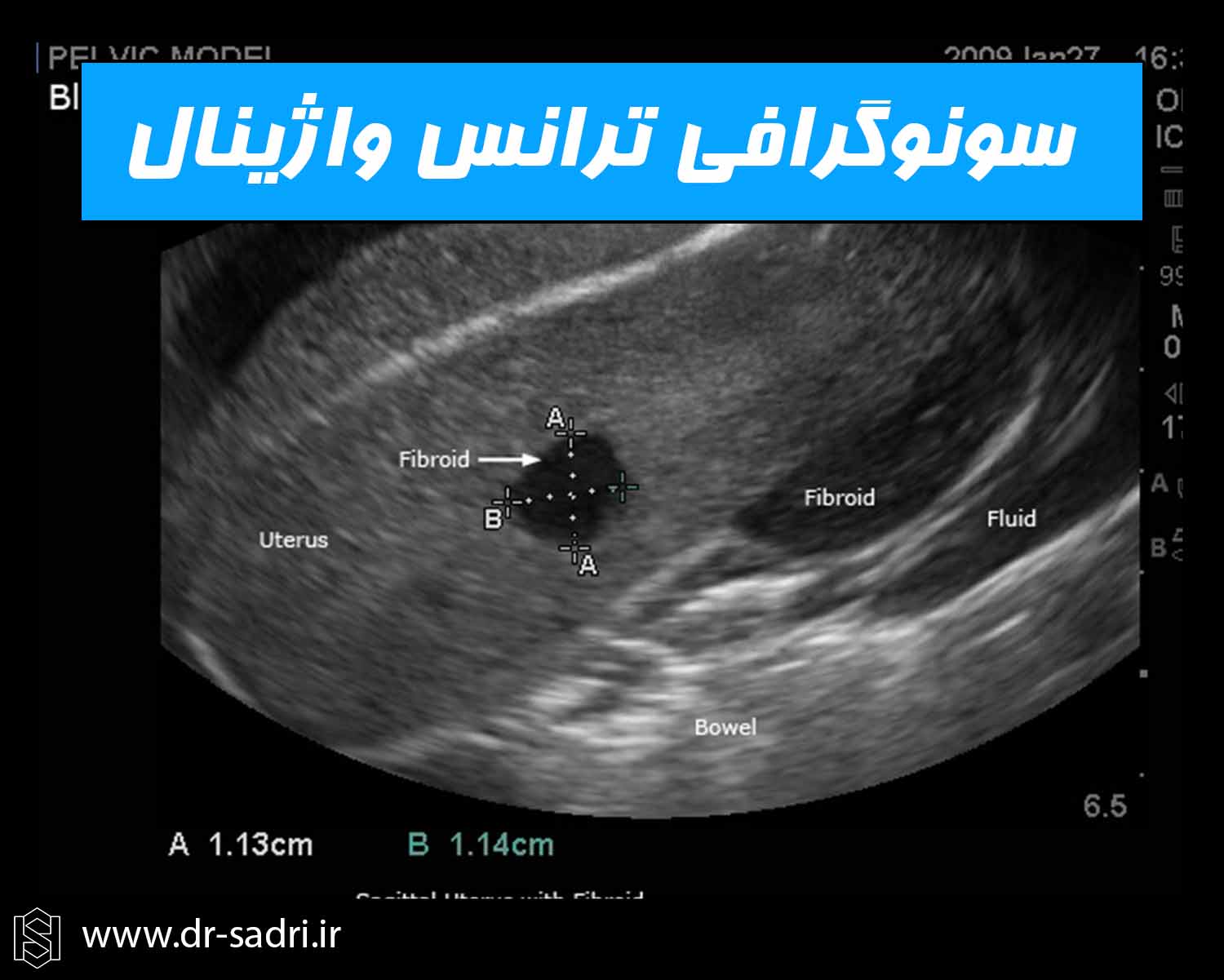 سونوگرافی ترانس واژینال