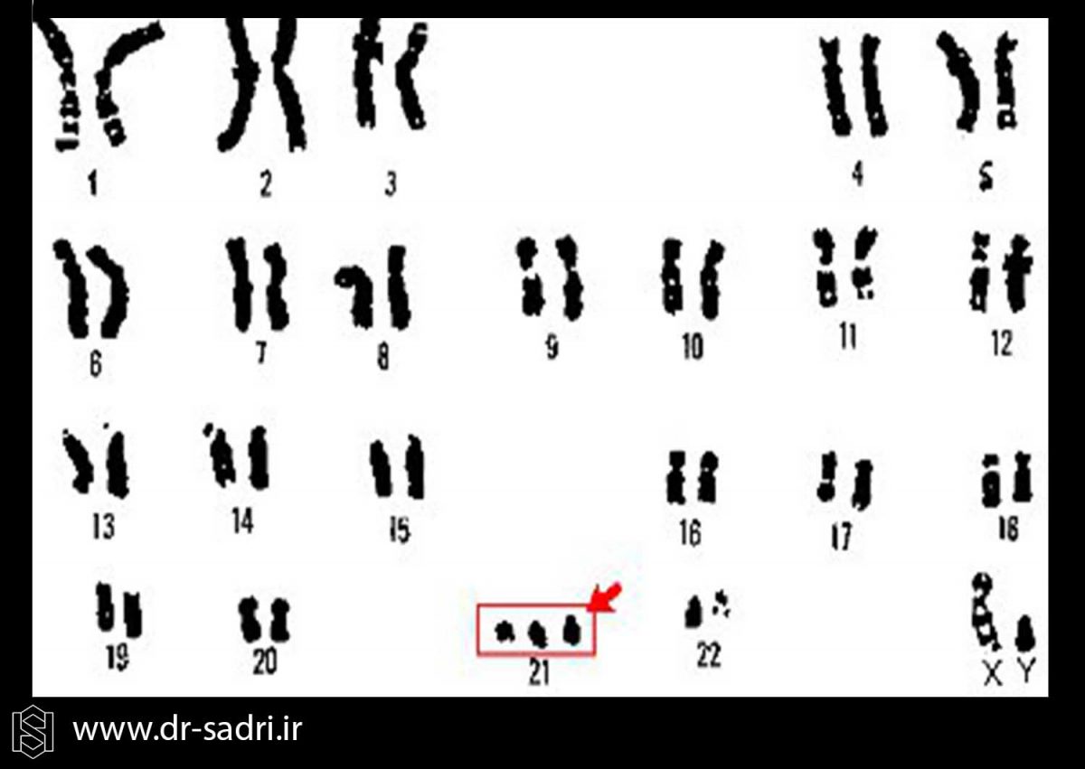 تریزومی 21 (Trisomy 21)