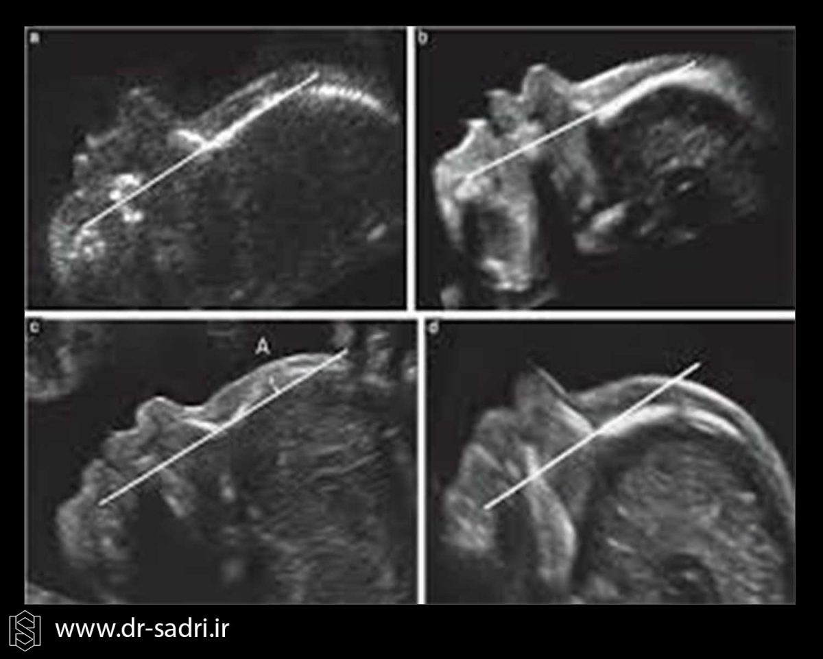 جا به جایی (Translocation)
