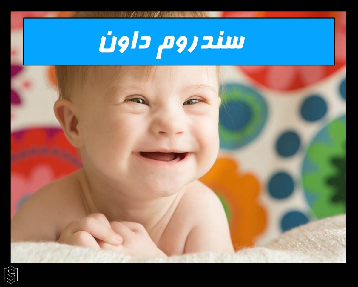 سندروم داون