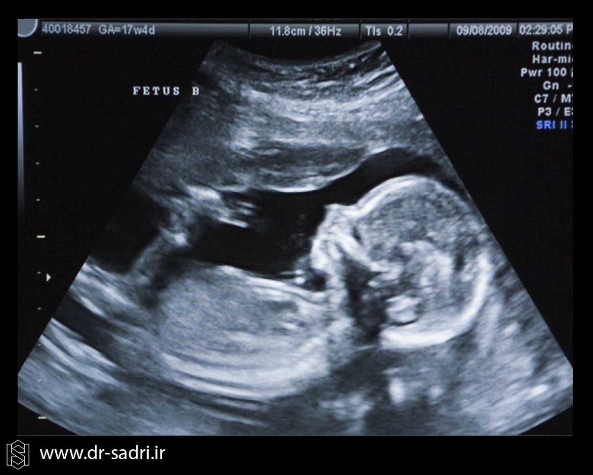 عکس جنین مبتلا به سندروم داون