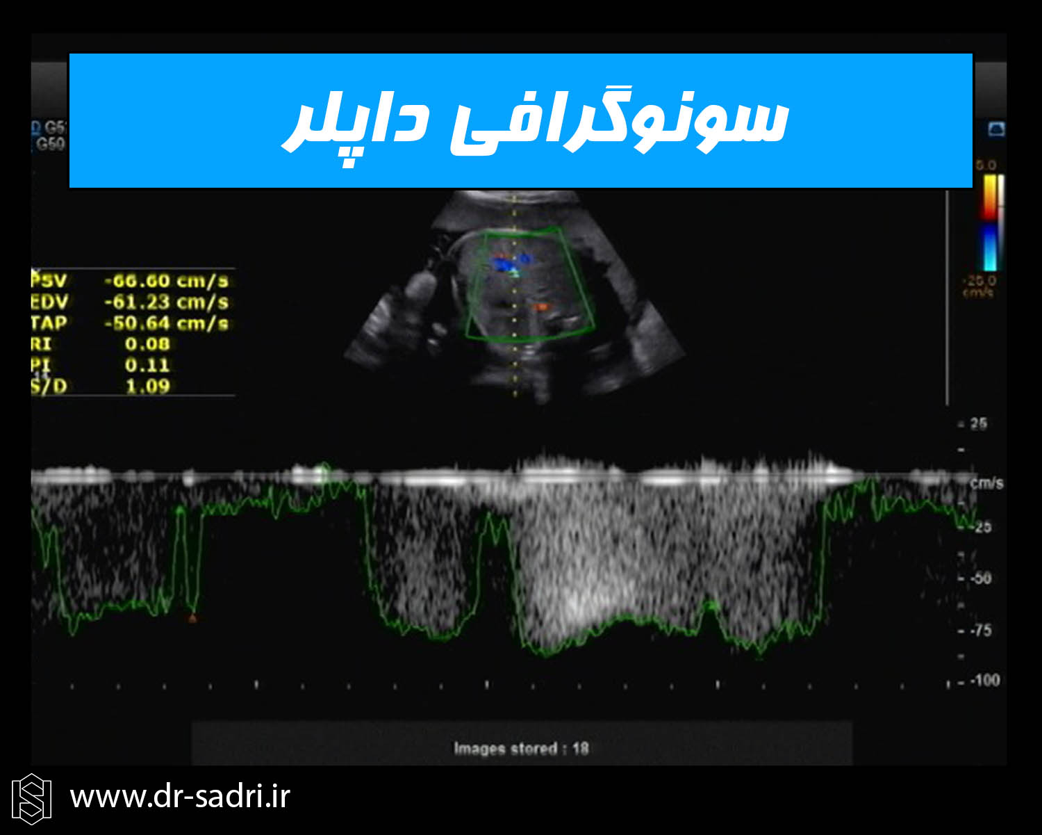 سونوگرافی داپلر