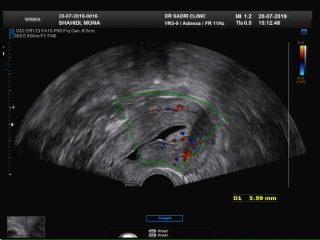 hystero sono سونوهیسترو