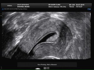 hystero sonography سونوهیستروگرافی