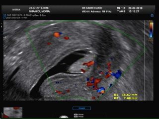 hystero sonography 2 هیسترو سونوگرافی