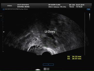 hystero ultrasound سونوگرافی هیسترو