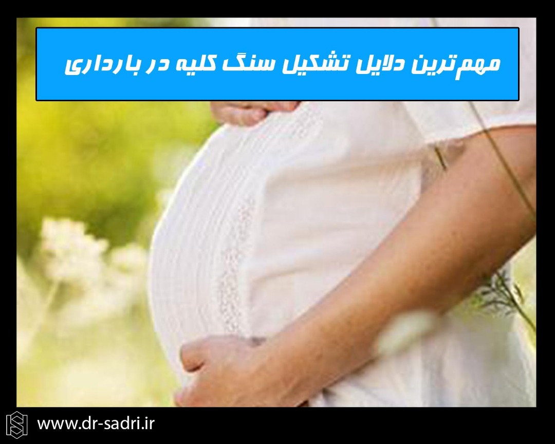 مهم ترین دلایل تشکیل سنگ کلیه در بارداری