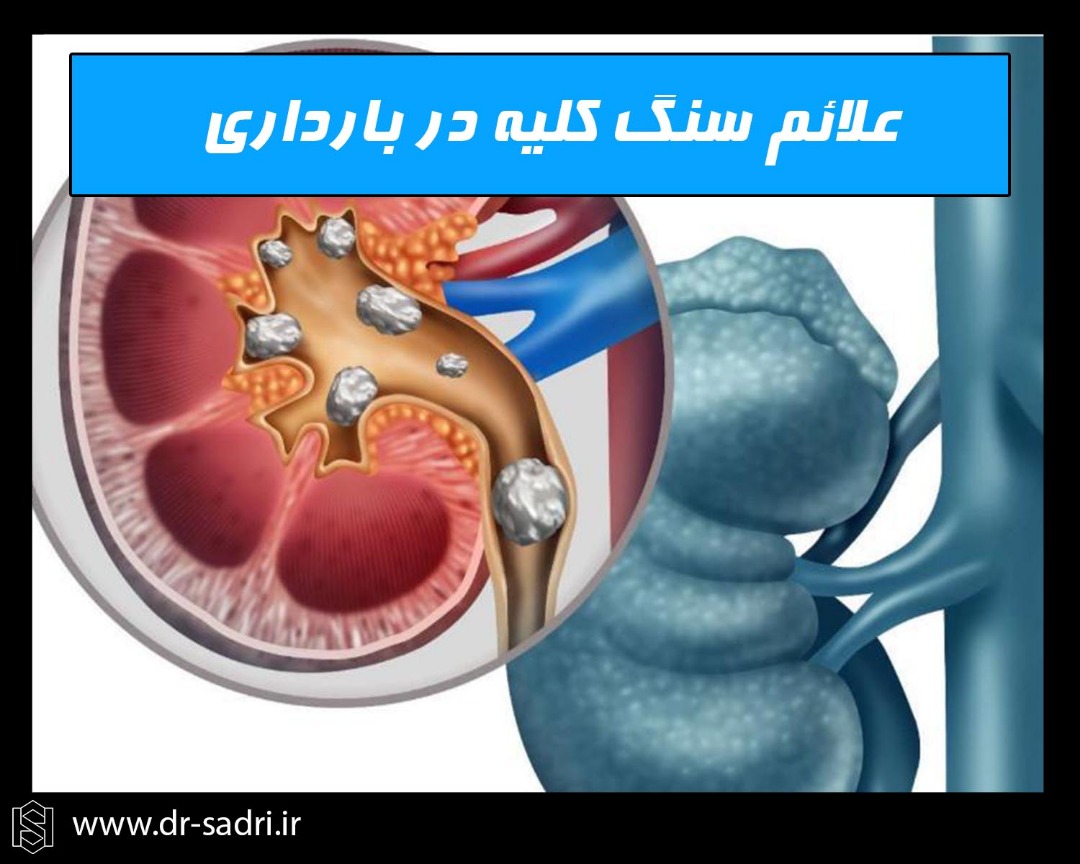 علایم سنگ کلیه در بارداری