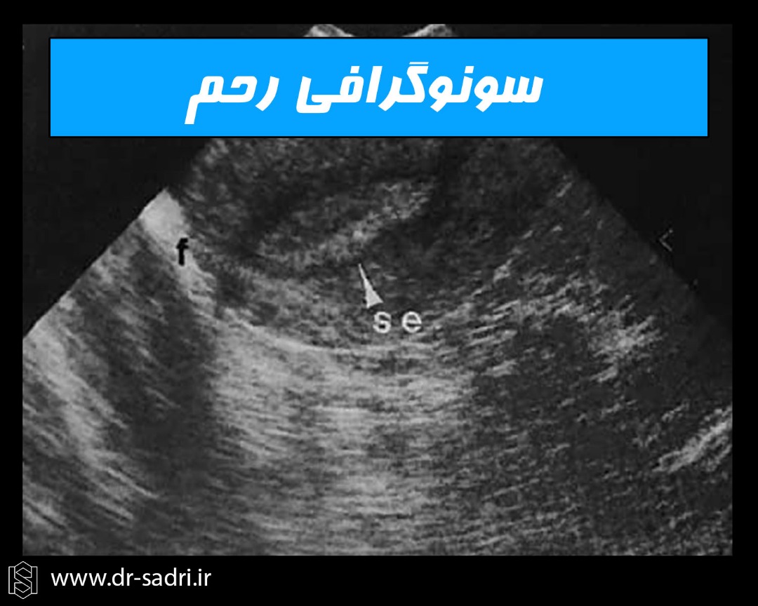 سونوگرافی رحم
