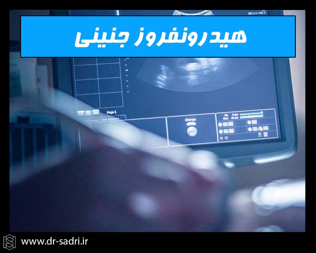 هیدرونفروز جنینی