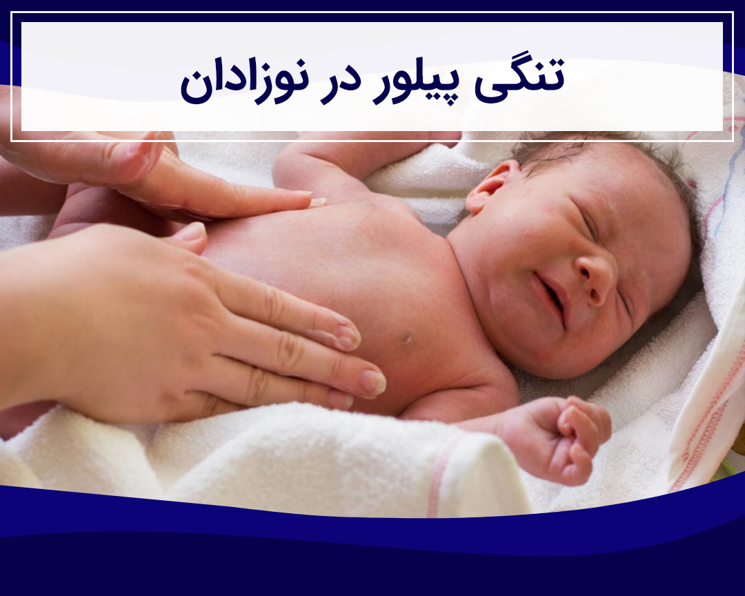 استنوز نوزادی، تنگی دریچه معده!